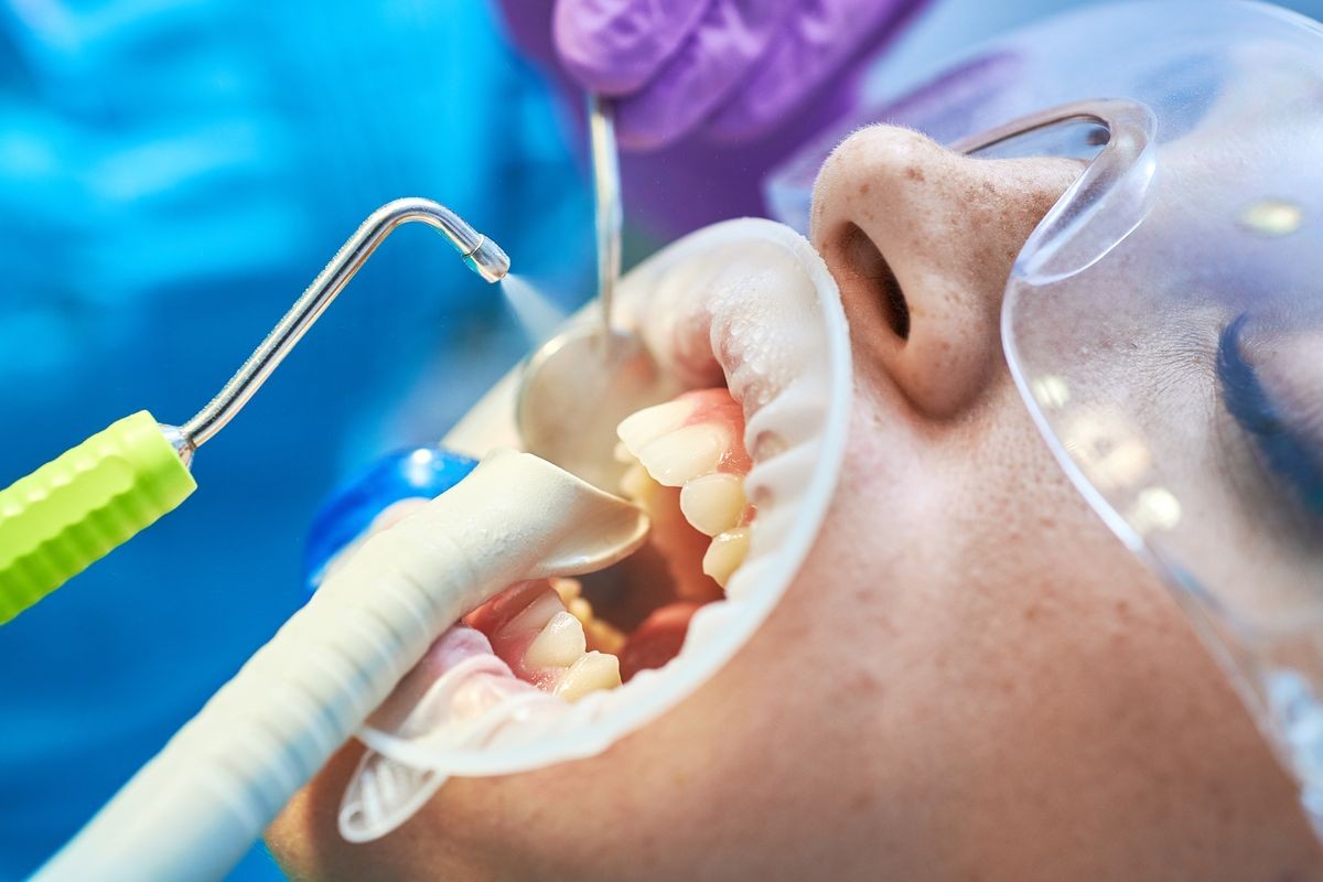 Dentist making professional teeth cleaning and polishing female young patient by  Dental Air Polisher at the dental office.   Removing Tooth Decay by Air Abrasion tool. Close-up plan.