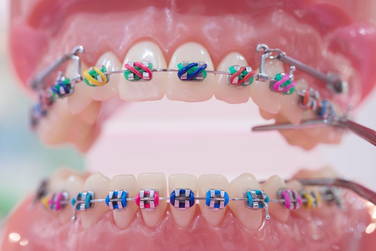 orthodontic model and dentist tool - demonstration teeth model of varities of orthodontic bracket or brace